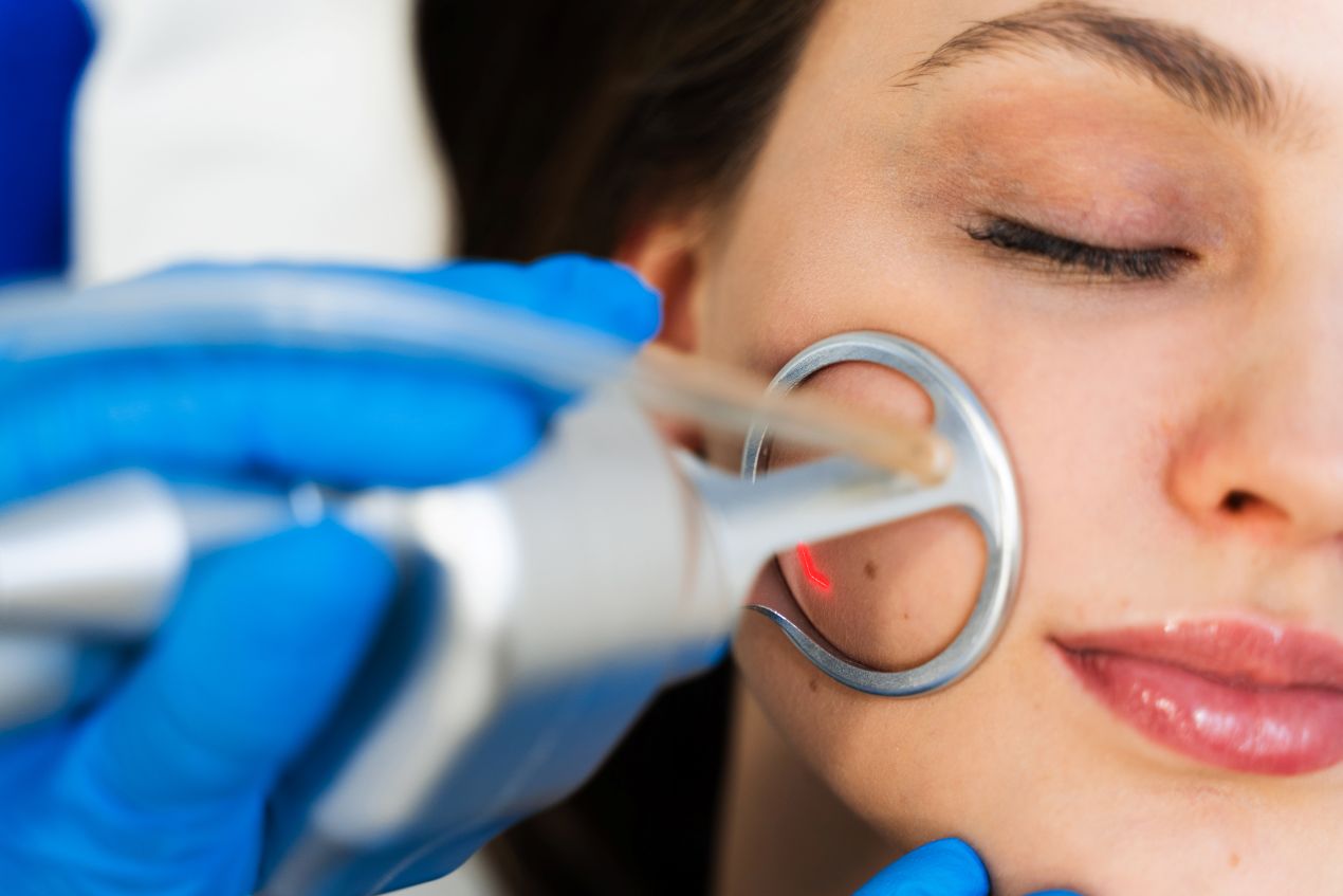 Dermatologe fuehrt gezielte Lasertherapie an der Wange durch um Pigmentflecken entfernen und Hautbild sichtbar zu verbessern